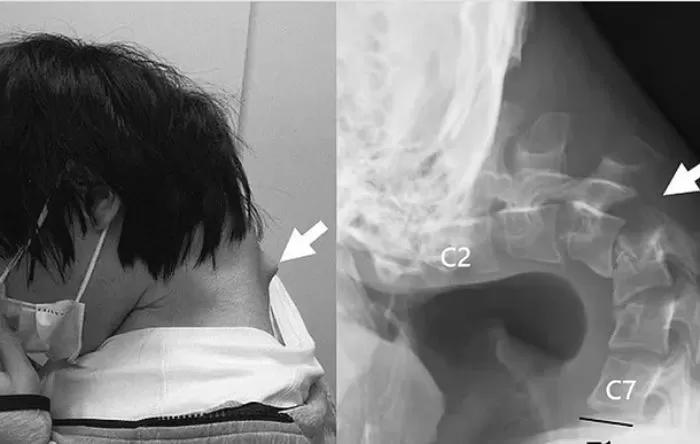 首が支えられない」…スマホに支配された身体が語る現代の“健康代償”と